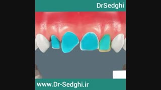 لمینیت سرامیکی