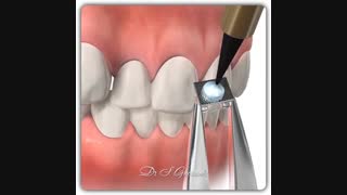 نصب براکت ارتودنسی | دکتر قریشی برداشتن خال گوشتی