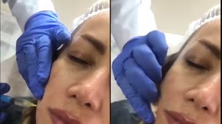 مزوتراپی صورت بلیچینگ