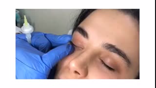 کربوکسی تراپی زیر چشم پریودنتیکس