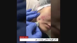 کربوکسی تراپی برای درمان آکنه درمان جای جوش