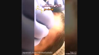 جوانسازی پیشانی با نخ دکتر پوست