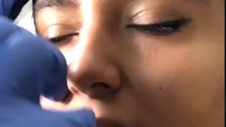 میکرودرم لیپوساکشن