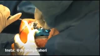 جراحی تعویض مفصل زانو