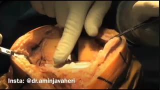 جراحی تعویض مفصل زانو توسط دکتر علیرضا امین جواهری