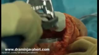 عمل جراحی تعویض مفصل زانو توسط دکتر جواهری