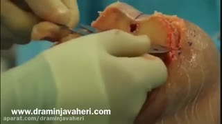 جراحی تعویض مفصل زانو توسط دکتر امین جواهری