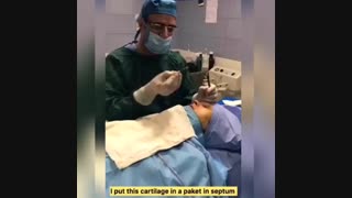 توضیح دکترمحمدگلى درمورد غضروف هاى اضافه انتهاى عمل