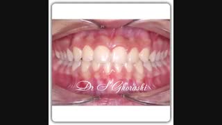 fixed orthodontics | dr.saeed ghorashi