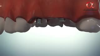 مراحل ایمپلنت دندان و اووردنچر بر پایه ایمپلنت به صورت کامل