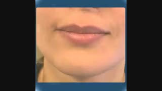 تزریق ژل لب در کلینیک زیبایی اشکان