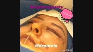 فیلم عمل بلفاروپلاستی پالپوتومی