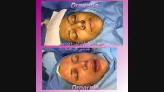 فیلم تزریق چربی رفع افتادگی پلک