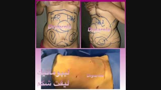 لیپوماتیک شکم کلینیک پوست