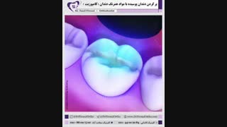 پر کردن دندان با آمالگام | دکتر فاضل فیروزی
