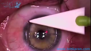 فیلم کامل  نحوه عمل لیزیک چشم