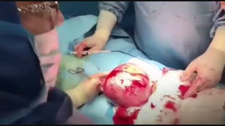جراحی فیبروم بزرگ