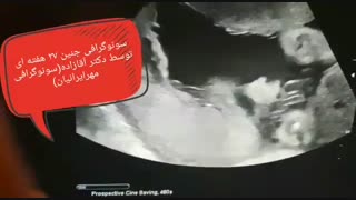 سونوگرافی جنین 27 هفته ای