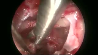 جراحی تومور قاعده جمجمه