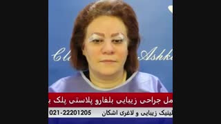 جراحی زیبایی پلک بالا