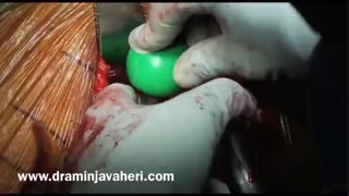 جراحی تعویض کامل مفصل لگن از طریق برش قدامی