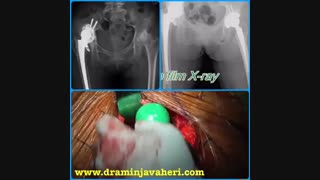 عمل جراحی تعویض کامل مفصل لگن از طریق روش آنتریور