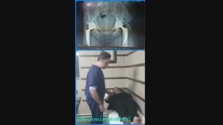 معاینه بیمار یکسال بعداز عمل جراحی تعویض مفصل دوطرفه لگن