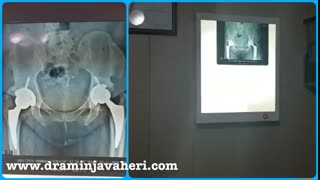 معاینه بیمار یکسال بعداز عمل جراحی تعویض مفصل دوطرفه لگن