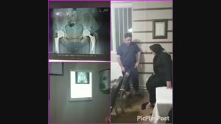 معاینه بیمار یکسال بعداز عمل جراحی تعویض مفصل دوطرفه لگن