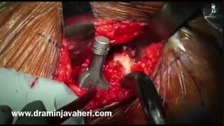 عمل جراحی تعویض کامل مفصل لگن اپروچ آنتریور