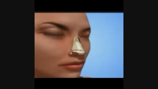 جراحی انحراف بینی