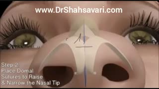 رینوپلاستی