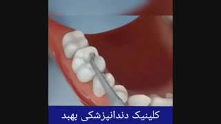 پر کردن دندان