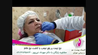 نخ لیفت و رفع غبغب با کاشت نخ pdo