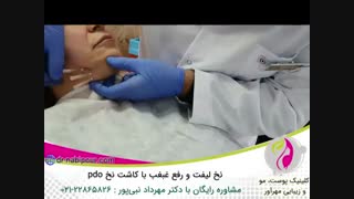 نخ لیفت و رفع غبغب با کاشت نخ pdo