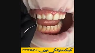 دندان های نامرتب - دندان های مرتب
