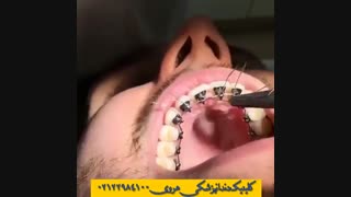 ارتودنسی لینگوال