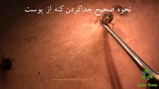 از بین بردن کنه در یک حرکت