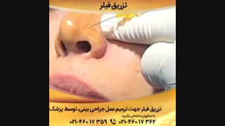 تزریق فیلر کشیدن دندان