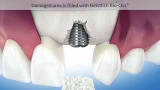 موفقیت جراحی ایمپلنت از طریق پیوند استخوان