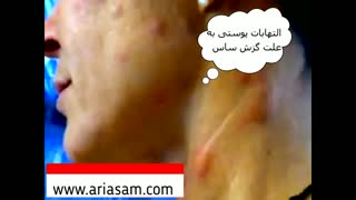 حساسیت های پوستی ناشی از گزش ساس