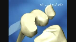 انیمیشن تعویض مفصل زانو