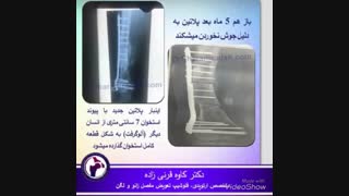 درمان شکستگی پا