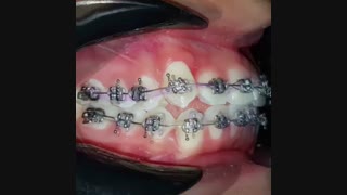 ارتودنسی دندان نیش