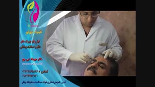 فیلر رفع چروک های دایم و استاتیک پیشانی