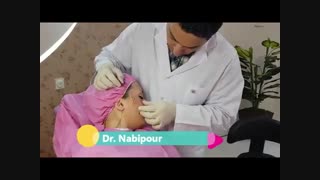 لیفت با نخ