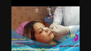 فیلر زیر چشم