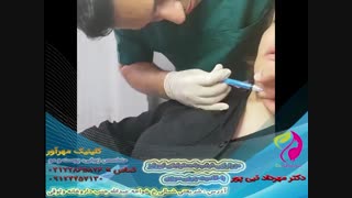 مزوتراپی غبغب با محلولهای لیپولیزر
