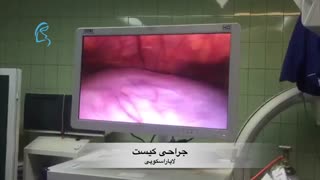 جراحی کیست لاپاراسکوپی