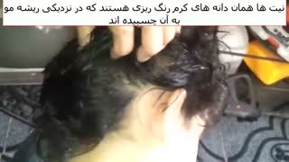 حمله صدها شپش به سر کودک !!!- نشانه های شپش